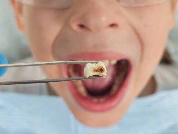 Best Chipped Tooth Repair Near Me  in Houston, TX
